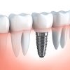 Dental Implant Cross Section