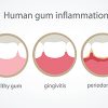Human Gum Inflamation