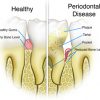 Healthy Teeth VS Periodontal