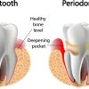 Healthy Tooth VS Periodontitis