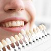 Teeth Whitening Shade Chart