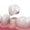 Premolar Dental Crown Placement