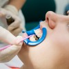 Dental Sealants