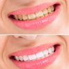 Before and After Teeth Whitening