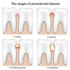 Stages of Periodontal Disease