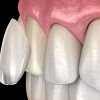 Dental Veneers