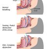 Sleep Apnea Diagram