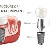 Structure of Dental Implants