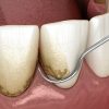 Teeth Scaling and Root Planing