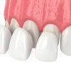 Beautiful Porcelain Veneers