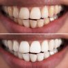 Teeth Whitening Before & After