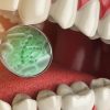 Bacteria and Microbes around Tooth