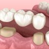 Dental Bridge Illustration