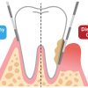 Periodontal Pockets