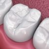 Tooth Colored Fillings