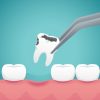 Tooth Extraction & Dry Socket