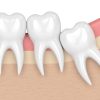 Wisdom Teeth Crowding